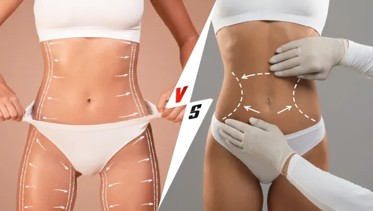 Liposuction vs. tummy tuck: which one is right for you?