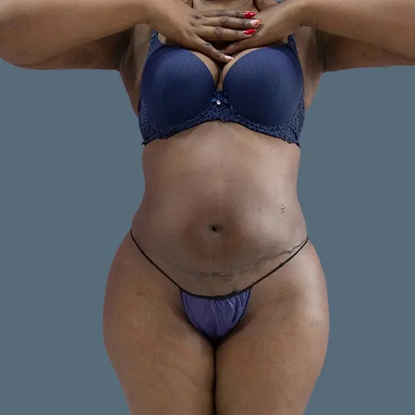 After body contouring case 01 front view at AJ Plastic Surgery Centre