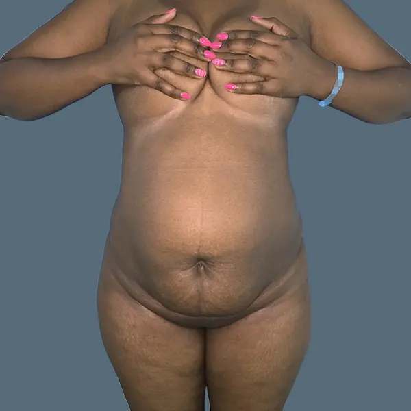 Before body contouring case 01 front view at AJ Plastic Surgery Centre