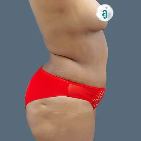 After body contouring case 02 side view at AJ Plastic Surgery Centre