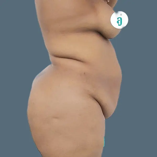 Before body contouring case 02 side view at AJ Plastic Surgery Centre