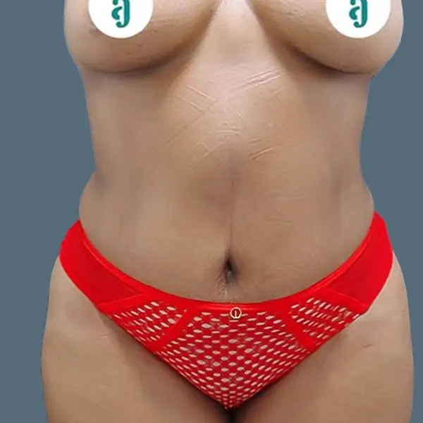 After body contouring case 03 front view at AJ Plastic Surgery Centre