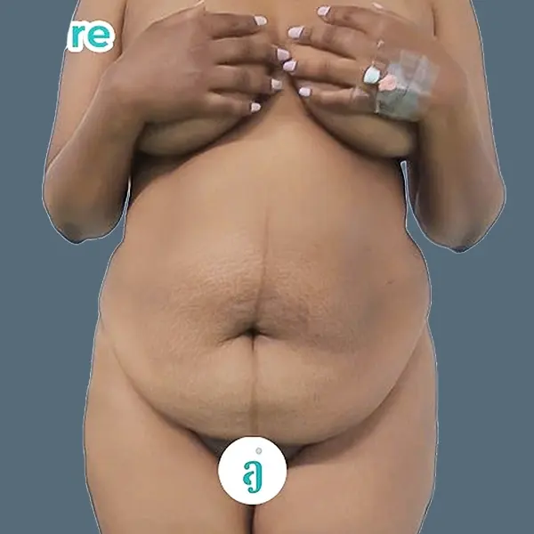 Before body contouring case 03 front view at AJ Plastic Surgery Centre