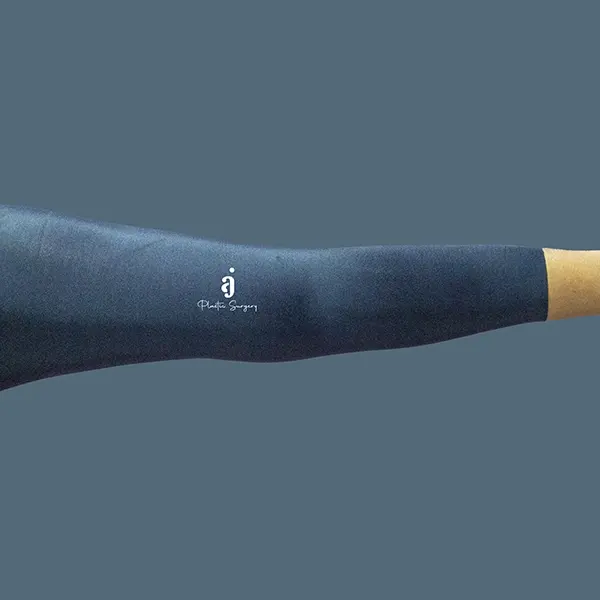 After brachioplasty / arm lift case 01 alternate arm view at AJ Plastic Surgery Centre