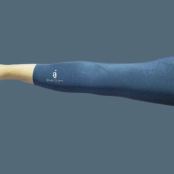 After brachioplasty / arm lift case 01 arm view at AJ Plastic Surgery Centre