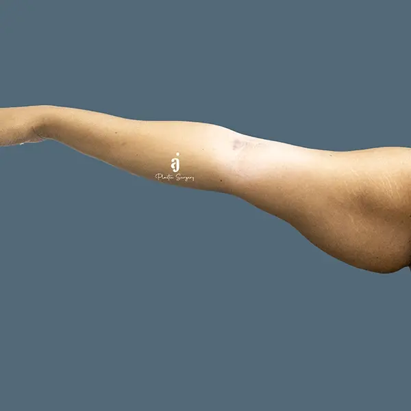 Before brachioplasty / arm lift case 01 arm view at AJ Plastic Surgery Centre
