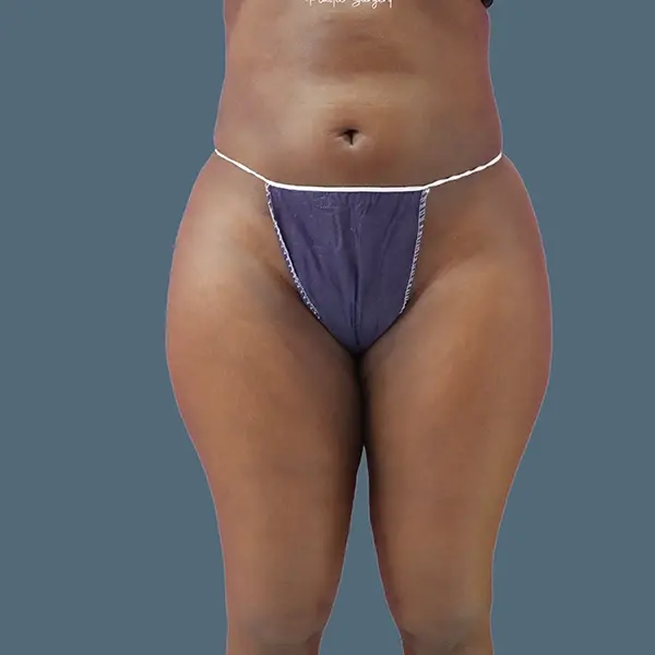 After brazilian butt lift case 01 front view at AJ Plastic Surgery Centre