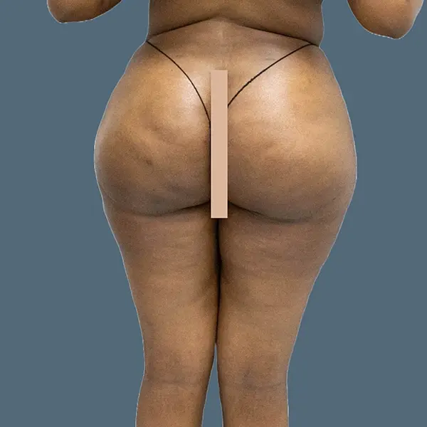 After brazilian butt lift case 02 back view at AJ Plastic Surgery Centre
