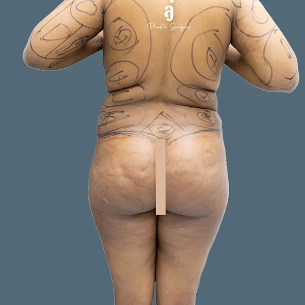 Before brazilian butt lift case 02 back view at AJ Plastic Surgery Centre