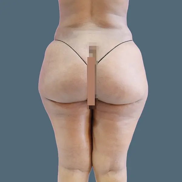 After brazilian butt lift case 03 back view at AJ Plastic Surgery Centre