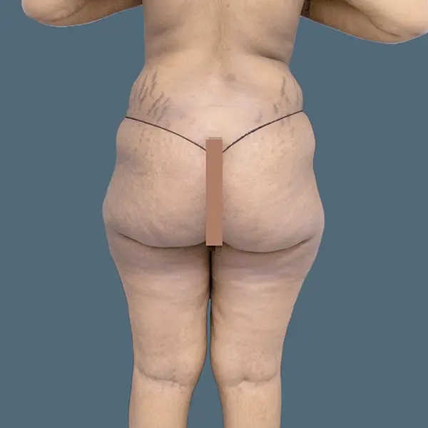 Before brazilian butt lift case 03 back view at AJ Plastic Surgery Centre