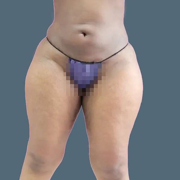 After brazilian butt lift case 03 front view at AJ Plastic Surgery Centre