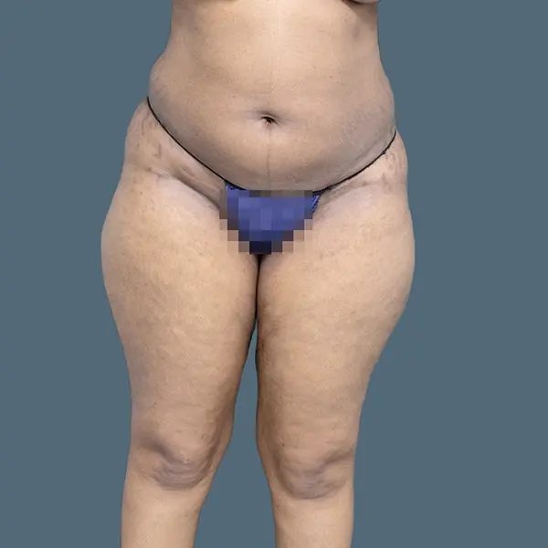 Before brazilian butt lift case 03 front view at AJ Plastic Surgery Centre