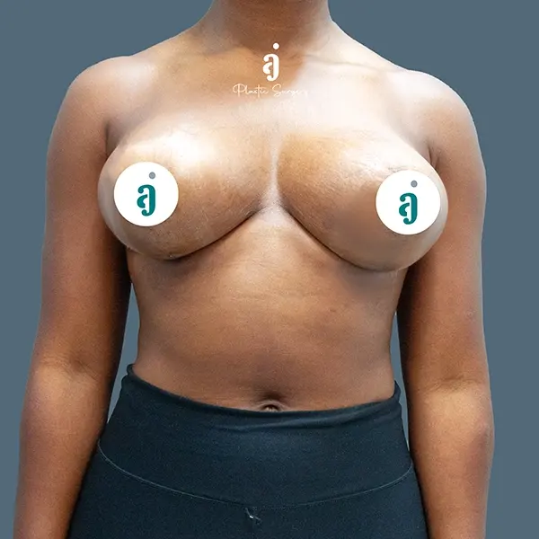 After breast lift case 01 front view at AJ Plastic Surgery Centre
