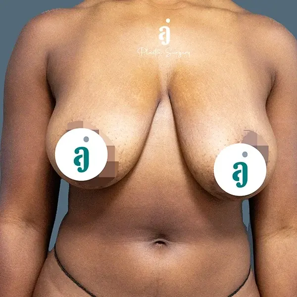 Before breast lift case 01 front view at AJ Plastic Surgery Centre