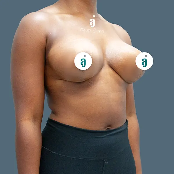 After breast lift case 01 oblique view at AJ Plastic Surgery Centre