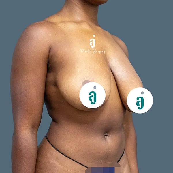 Before breast lift case 01 oblique view at AJ Plastic Surgery Centre