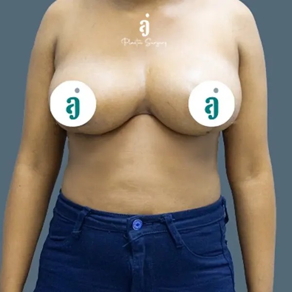 After breast lift case 02 front view at AJ Plastic Surgery Centre