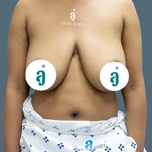 Before breast lift case 02 front view at AJ Plastic Surgery Centre