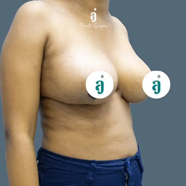 After breast lift case 02 oblique view at AJ Plastic Surgery Centre