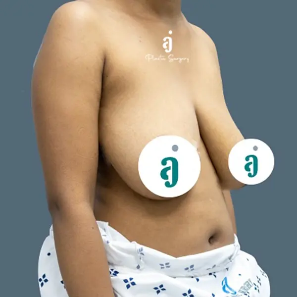 Before breast lift case 02 oblique view at AJ Plastic Surgery Centre