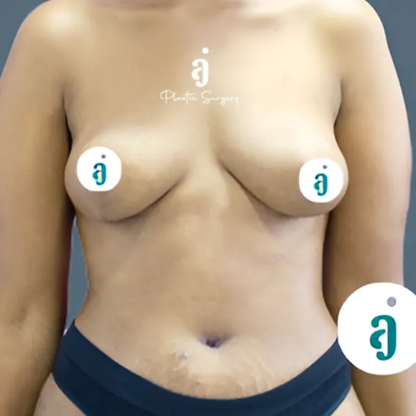 After breast lift case 03 front view at AJ Plastic Surgery Centre