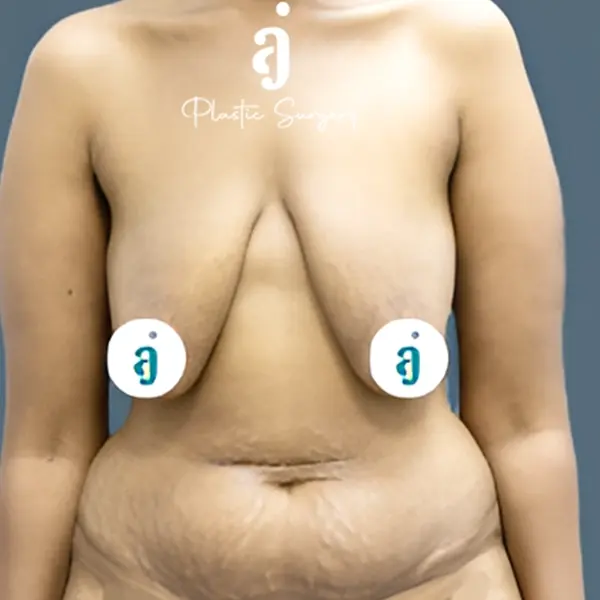 Before breast lift case 03 front view at AJ Plastic Surgery Centre
