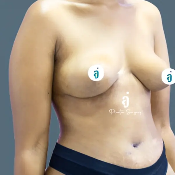 After breast lift case 03 oblique view at AJ Plastic Surgery Centre