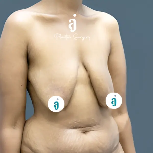 Before breast lift case 03 oblique view at AJ Plastic Surgery Centre