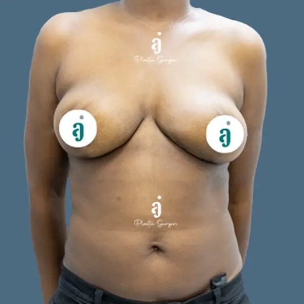 After breast reduction case 01 alternate view at AJ Plastic Surgery Centre
