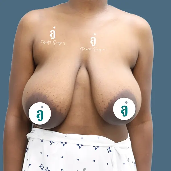 Before breast reduction case 01 alternate view at AJ Plastic Surgery Centre