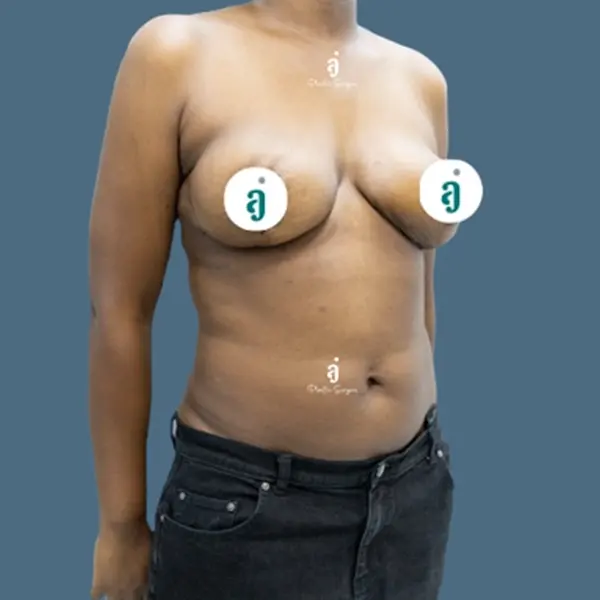 After breast reduction case 01 front view at AJ Plastic Surgery Centre