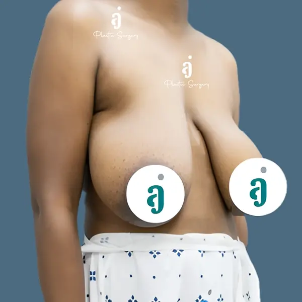 Before breast reduction case 01 front view at AJ Plastic Surgery Centre