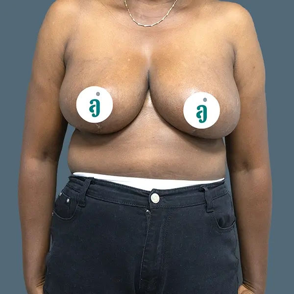 After breast reduction case 02 alternate view at AJ Plastic Surgery Centre
