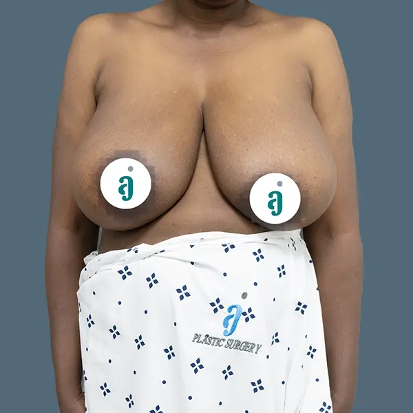 Before breast reduction case 02 alternate view at AJ Plastic Surgery Centre