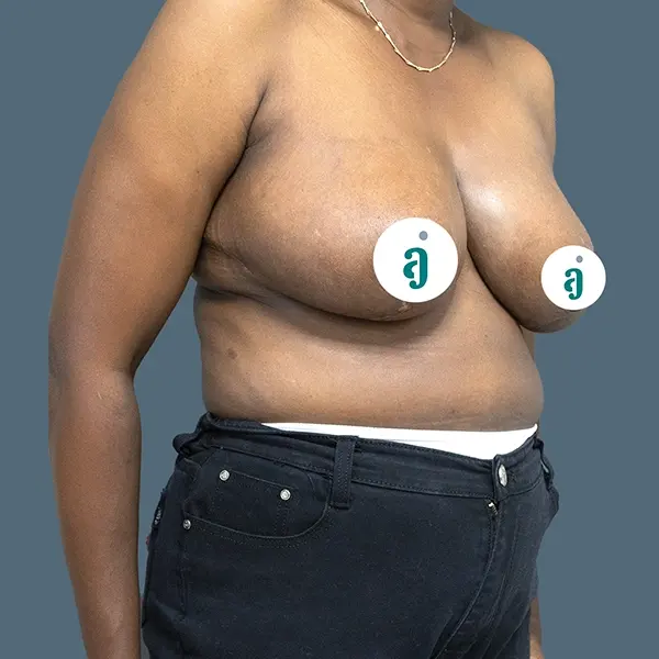 After breast reduction case 02 front view at AJ Plastic Surgery Centre
