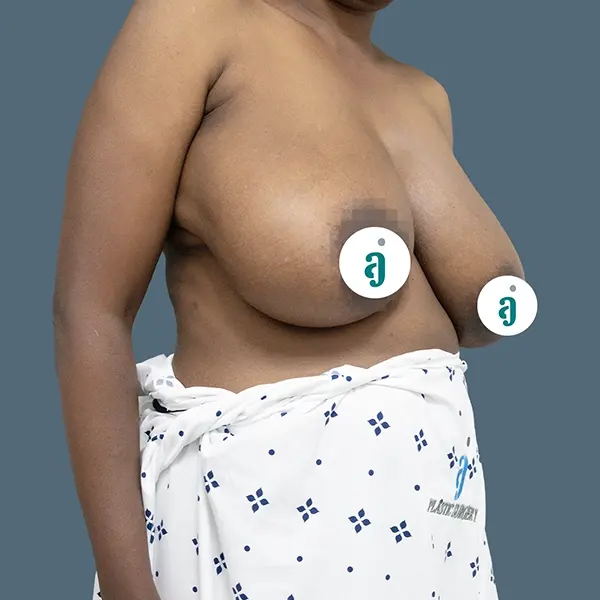 Before breast reduction case 02 front view at AJ Plastic Surgery Centre