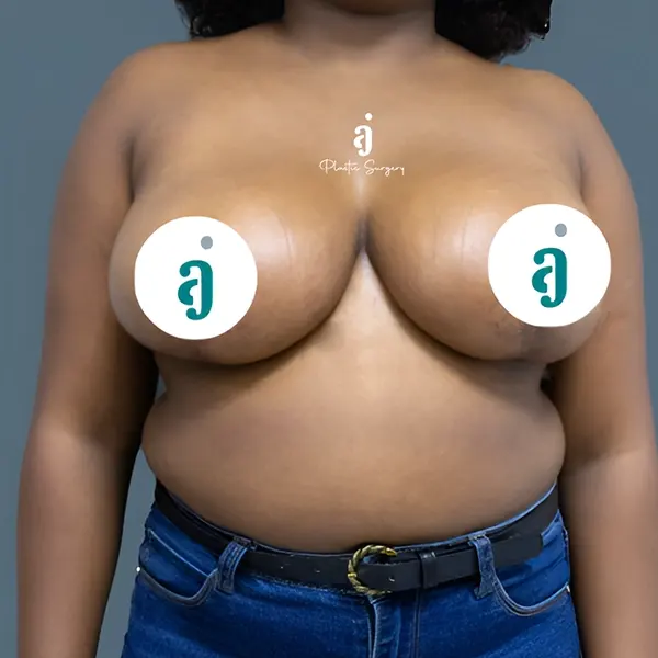 After breast reduction case 03 front view at AJ Plastic Surgery Centre