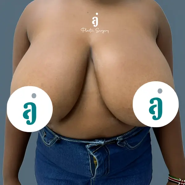 Before breast reduction case 03 front view at AJ Plastic Surgery Centre