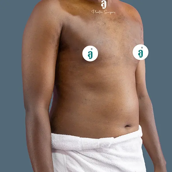 After gynaecomastia surgery case 01 alternate view at AJ Plastic Surgery Centre