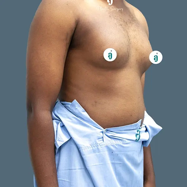 Before gynaecomastia surgery case 01 alternate view at AJ Plastic Surgery Centre