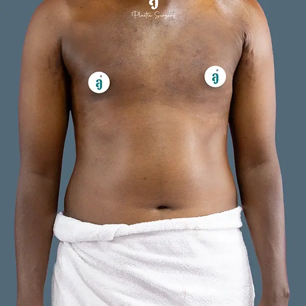 After gynaecomastia surgery case 01 front view at AJ Plastic Surgery Centre