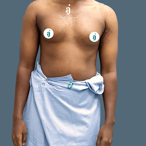 Before gynaecomastia surgery case 01 front view at AJ Plastic Surgery Centre