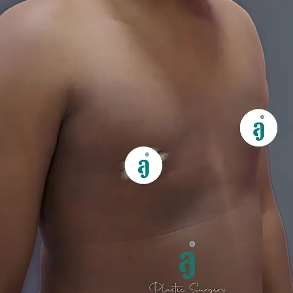 After gynaecomastia surgery case 02 alternate view at AJ Plastic Surgery Centre