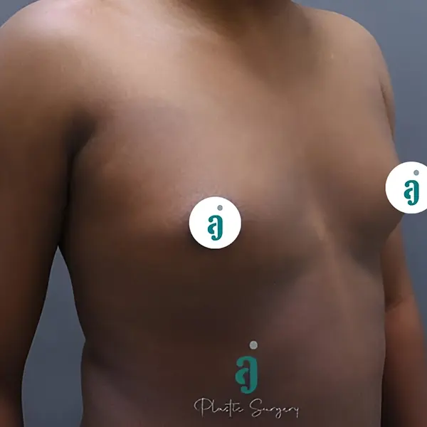 Before gynaecomastia surgery case 02 alternate view at AJ Plastic Surgery Centre