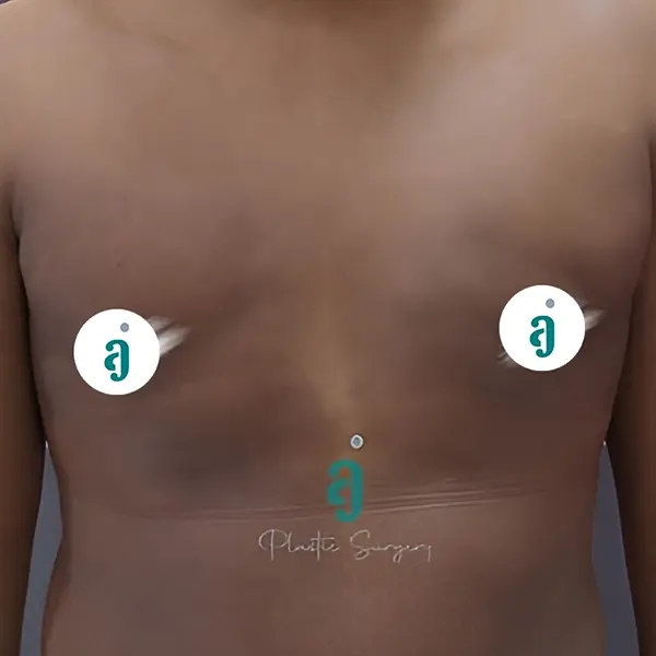 After gynaecomastia surgery case 02 front view at AJ Plastic Surgery Centre