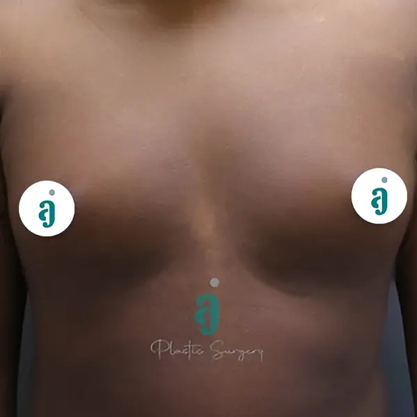 Before gynaecomastia surgery case 02 front view at AJ Plastic Surgery Centre