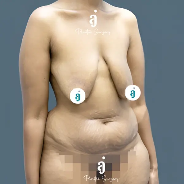 Before mommy makeover case 01 alternate view at AJ Plastic Surgery Centre