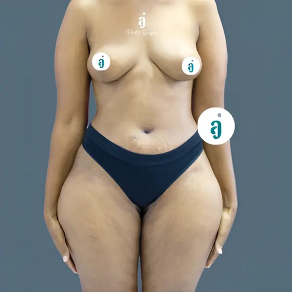 After mommy makeover case 01 front view at AJ Plastic Surgery Centre