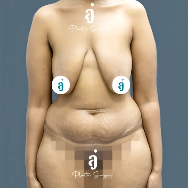 Before mommy makeover case 01 front view at AJ Plastic Surgery Centre